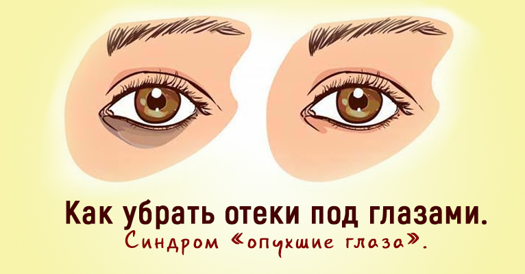 Синдром «опухшие глаза»: как убрать отеки под глазами