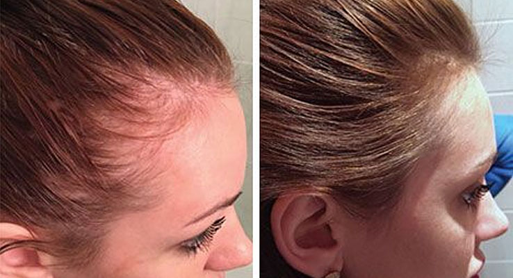 4 естественных способа восстановления волос за 10 дней
